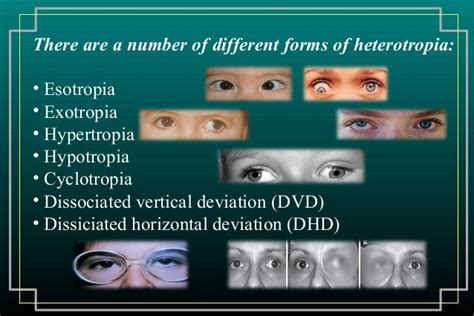 馬竇氏鏡|Motor Signs in Heterophoria and Heterotropia